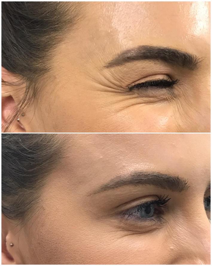 Personal lines and wrinkles consultation