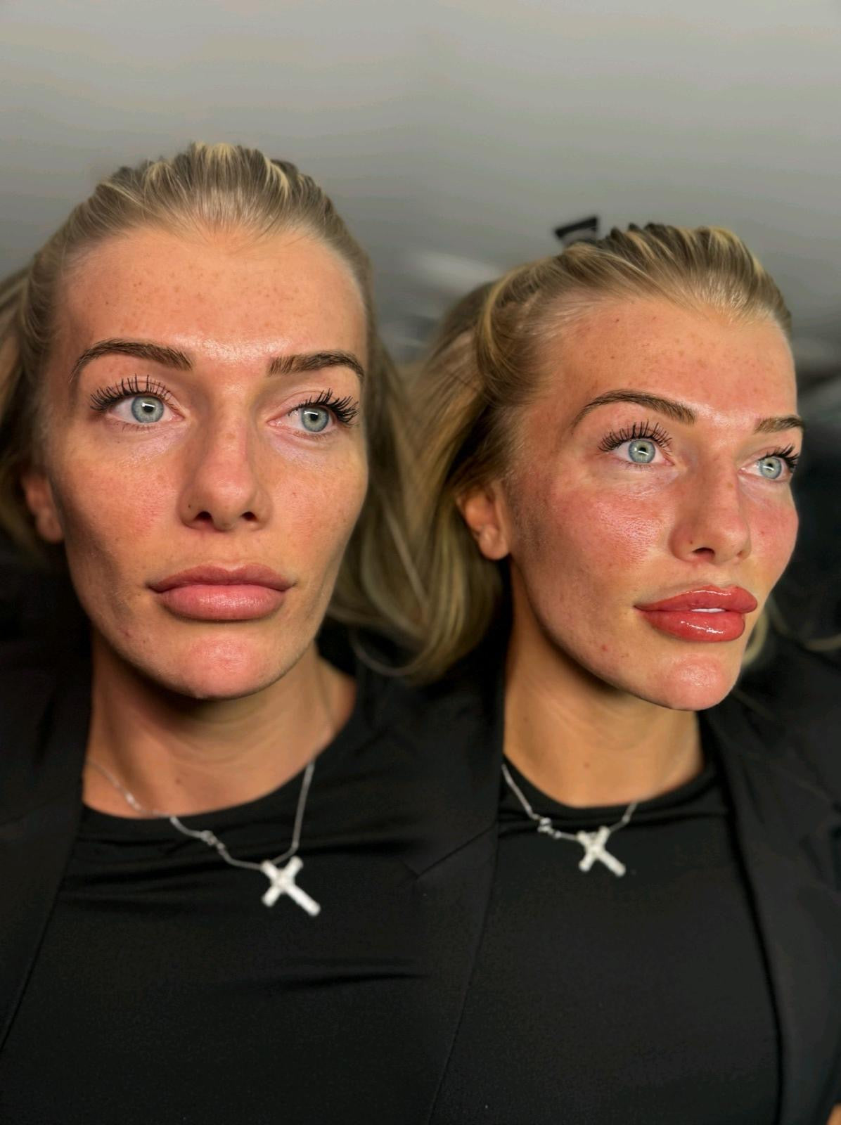 Featured HCH Aesthetics treatment result