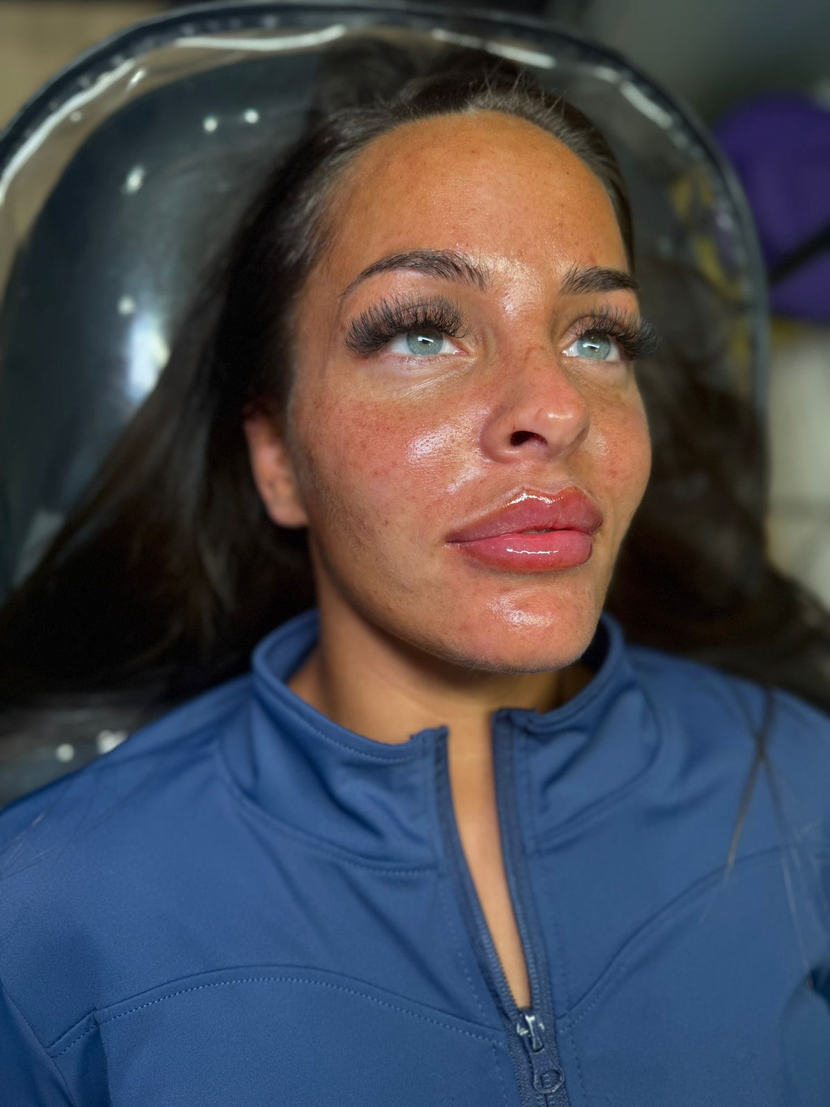Personalised lip filler consultation at HCH Aesthetics