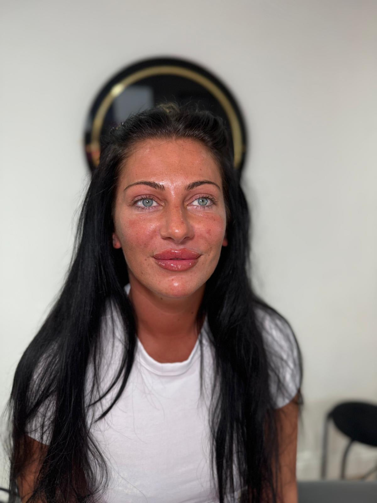 Skin rejuvenation treatment at HCH Aesthetics