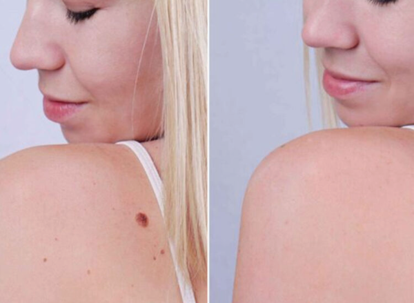 Professional skin lesion assessment and removal