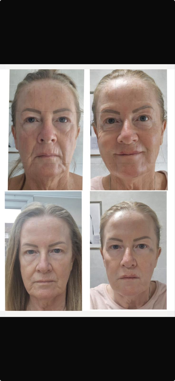 Lines and wrinkles consultation at HCH Aesthetics