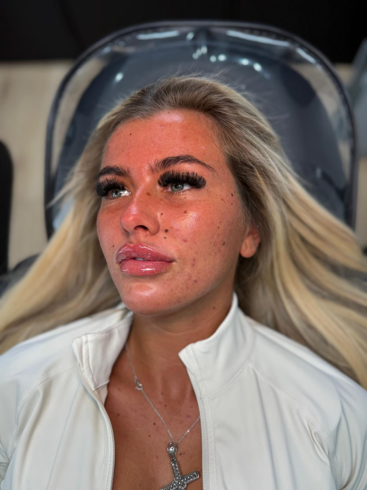 Natural-looking HCH Aesthetics result