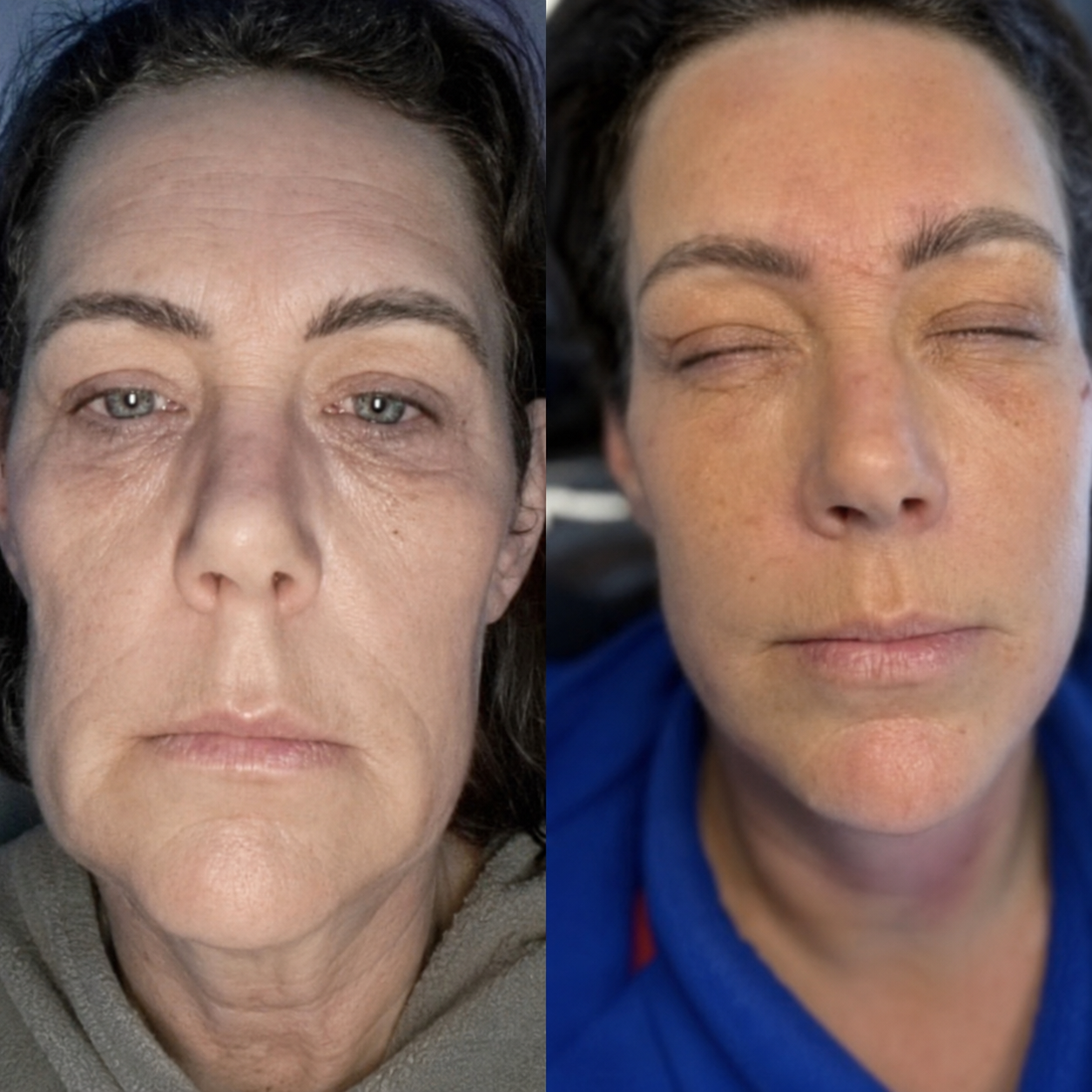 Lines and wrinkles consultation at HCH Aesthetics