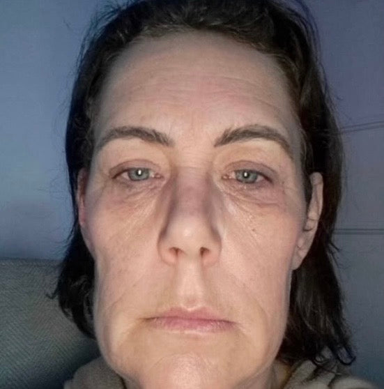 Before skin rejuvenation at HCH Aesthetics