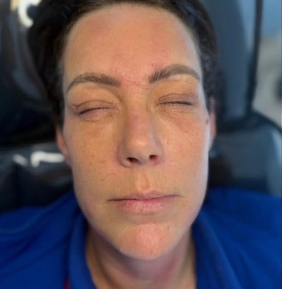After skin rejuvenation at HCH Aesthetics