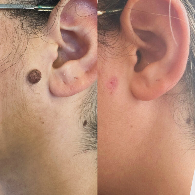Personalised skin lesion consultation at HCH Aesthetics