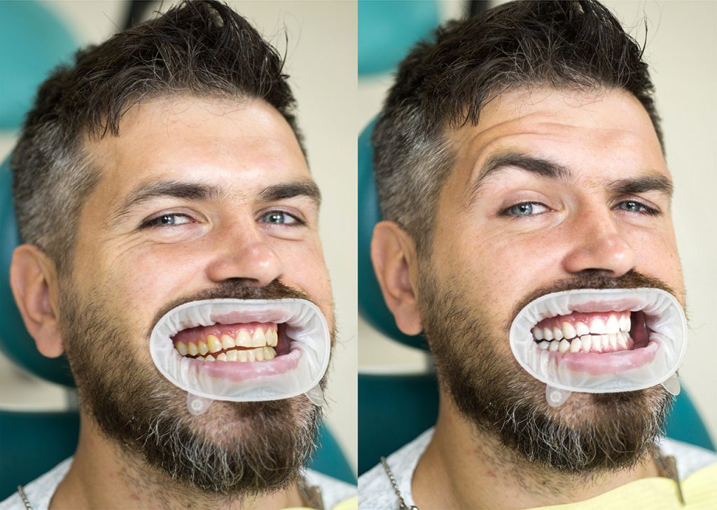 Professional teeth whitening treatment