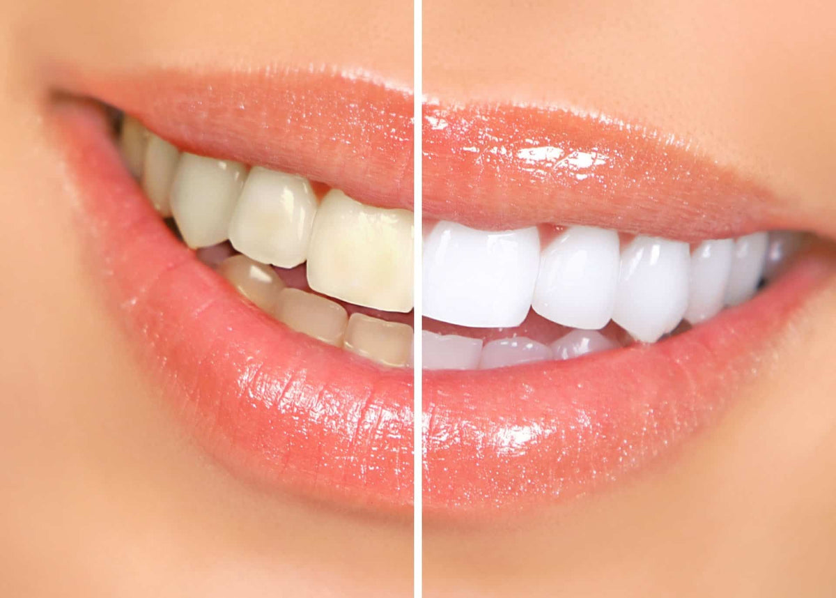 Personalised teeth whitening consultation at HCH Aesthetics
