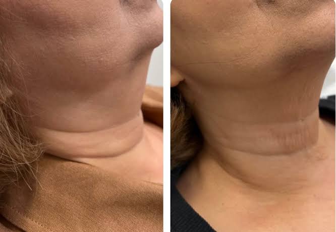 Lemon Bottle targeted fat dissolving treatment