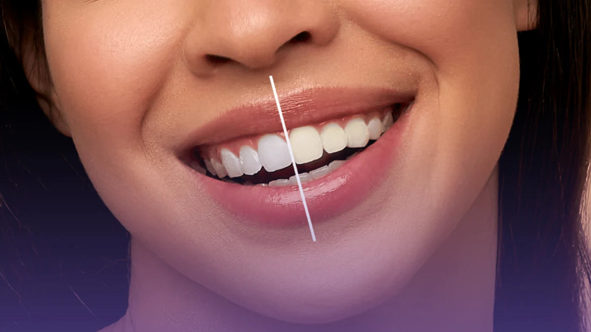 HCH Aesthetics teeth whitening experience